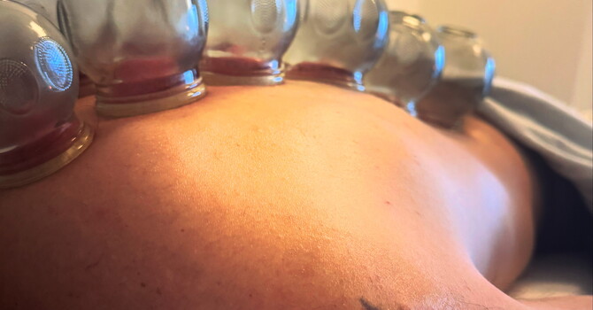 𝗙𝗶𝗿𝗲 𝗰𝘂𝗽𝗽𝗶𝗻𝗴 isn’t just a trendy treatment... image